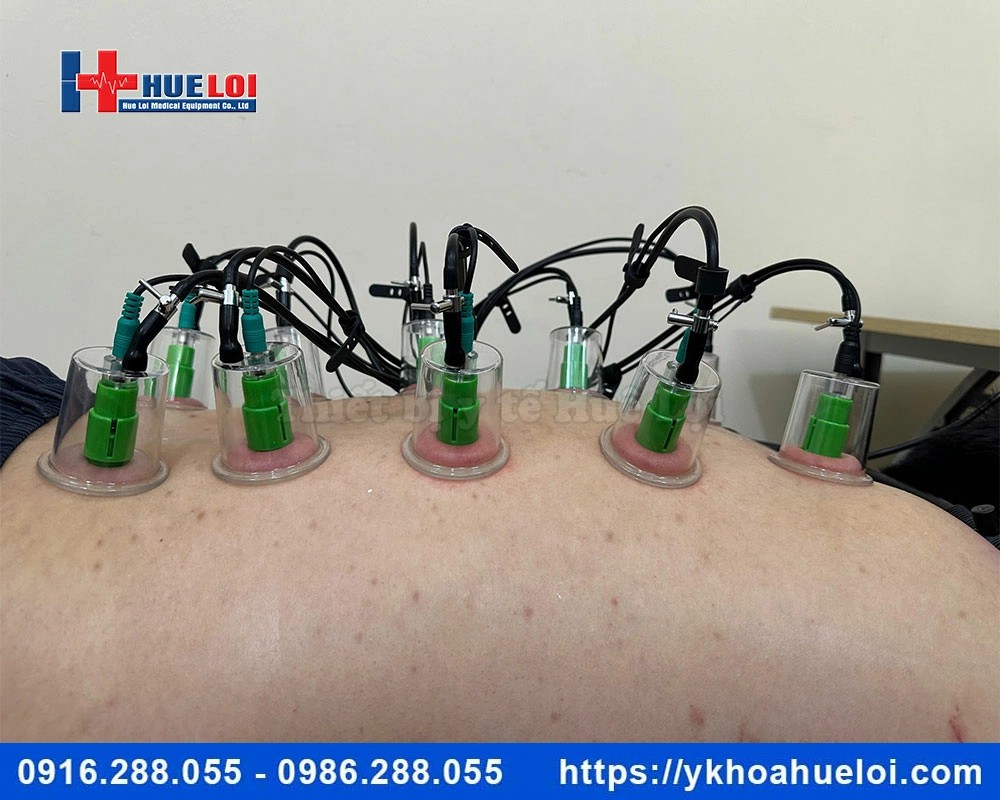 Máy điện châm ko kim kết hợp giác hút