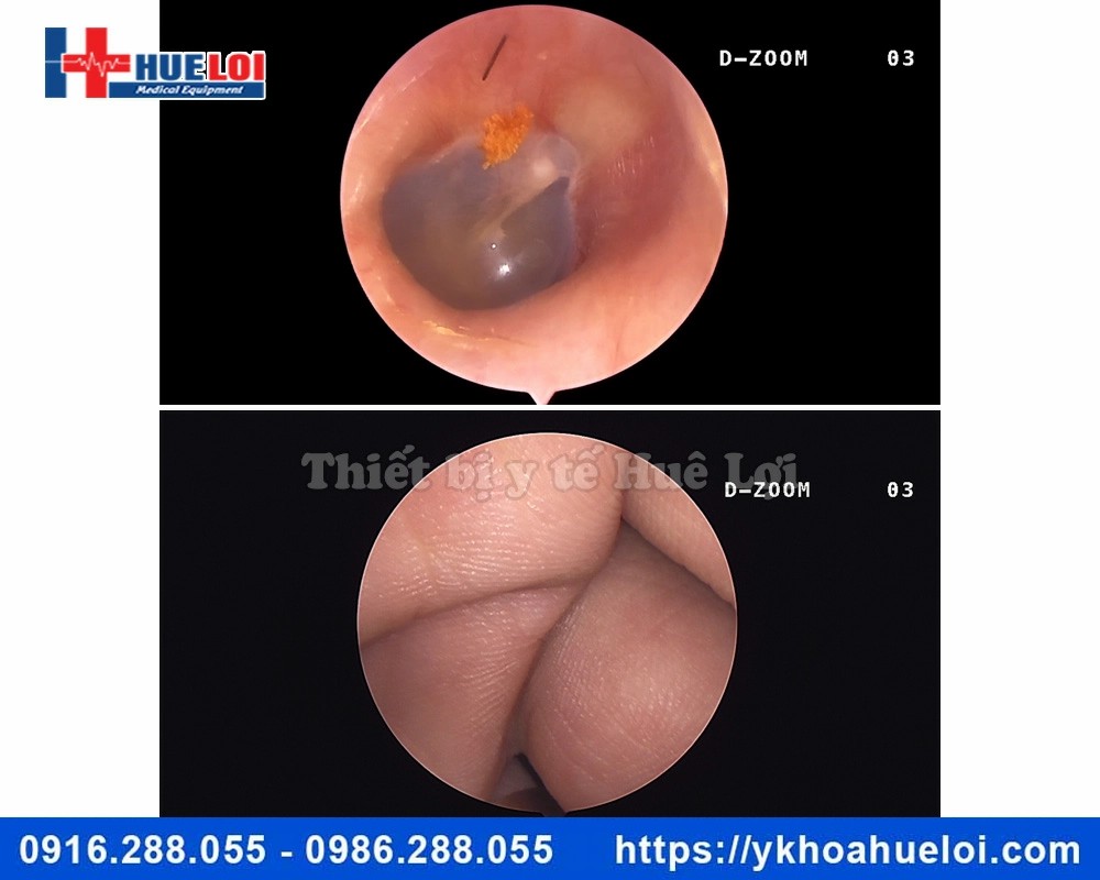 máy nội soi tai mũi họng full HD NCM-24