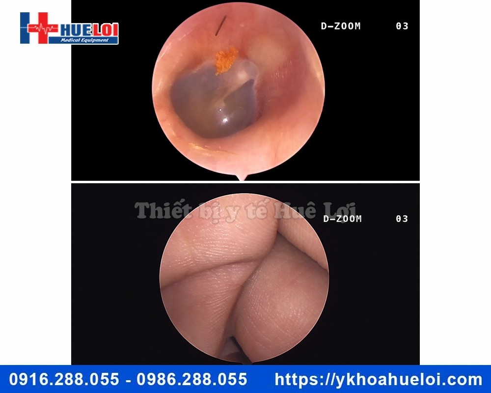 Máy nội soi tai mũi họng full HD NCM-24