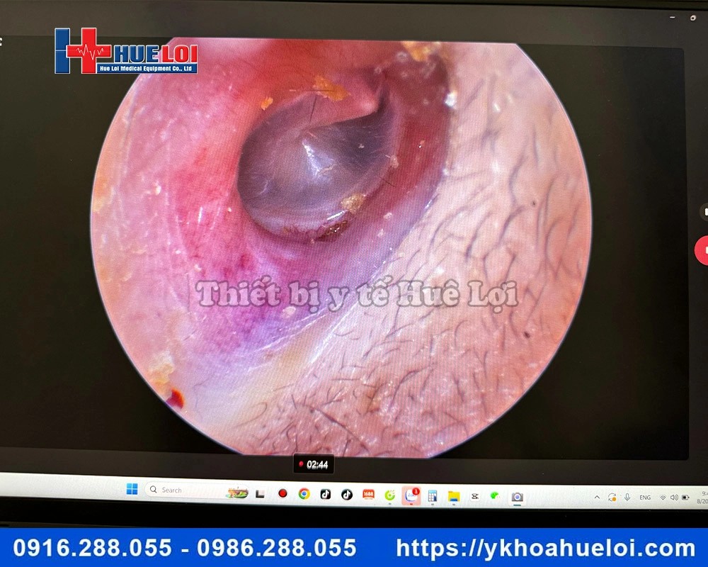 Máy nội soi tai mũi họng mini full HD