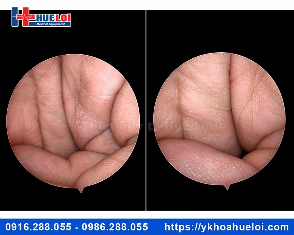 Máy nội soi Tai Mũi Họng Mini Full HD