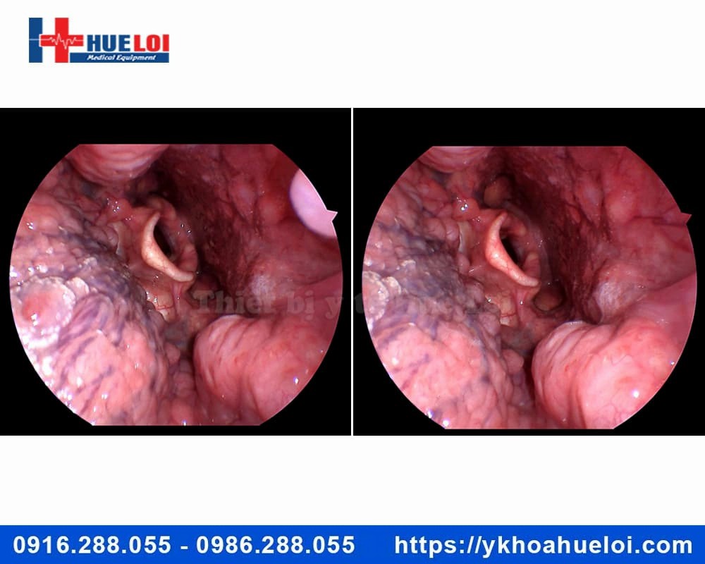 Máy nội soi Tai Mũi Họng Mini Full HD