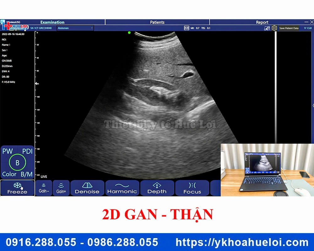 Máy siêu âm cầm tay 3 đầu dò C5 Plus