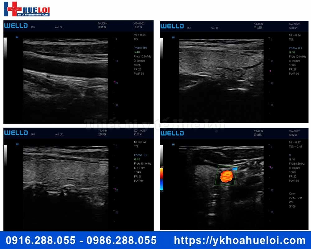 Máy siêu âm cảm ứng xách tay Doppler màu P10