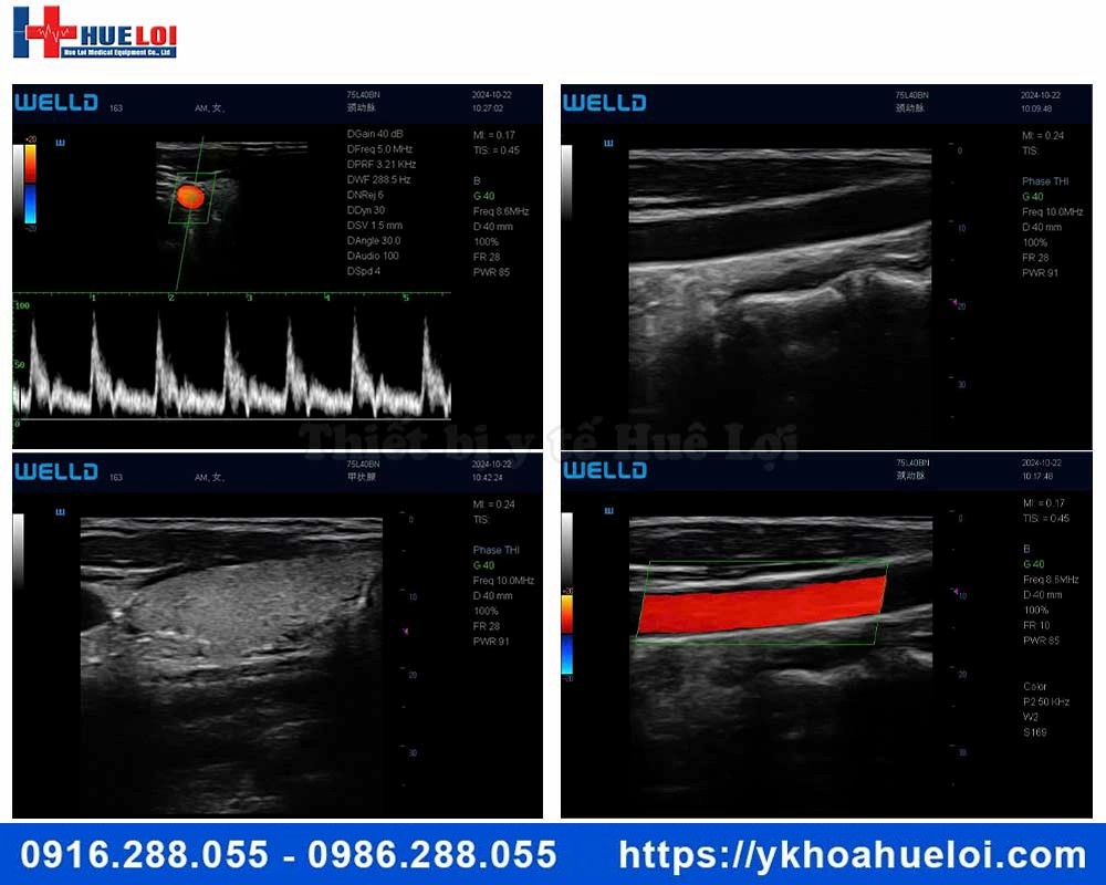 Máy siêu âm cảm ứng xách tay Doppler màu P10